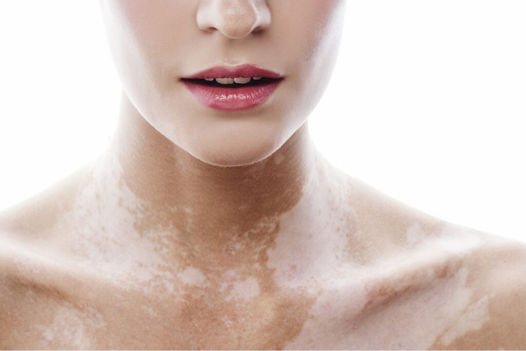 Vitiligo and Skincare