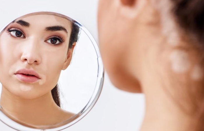 Why Is Skin Care Important for People with Vitiligo_
