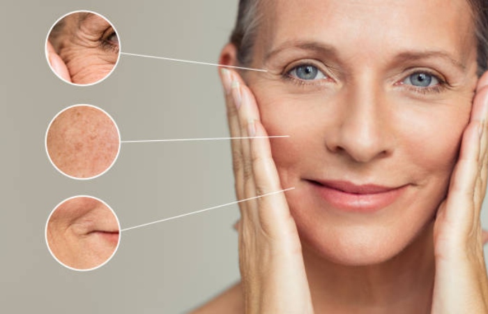 Moderate complications from dermal fillers
