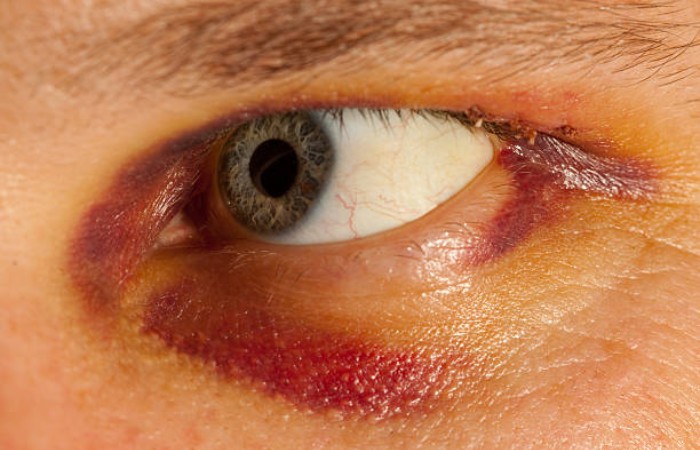 Scar Discolouration Treatment