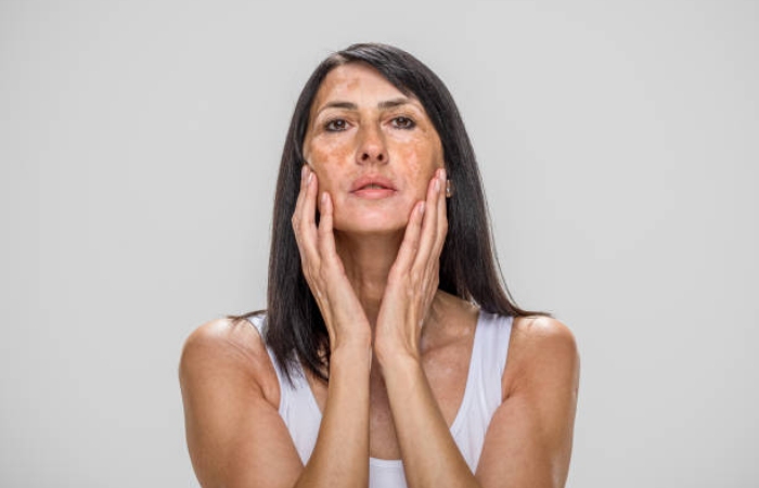 What is Taurine skin aging