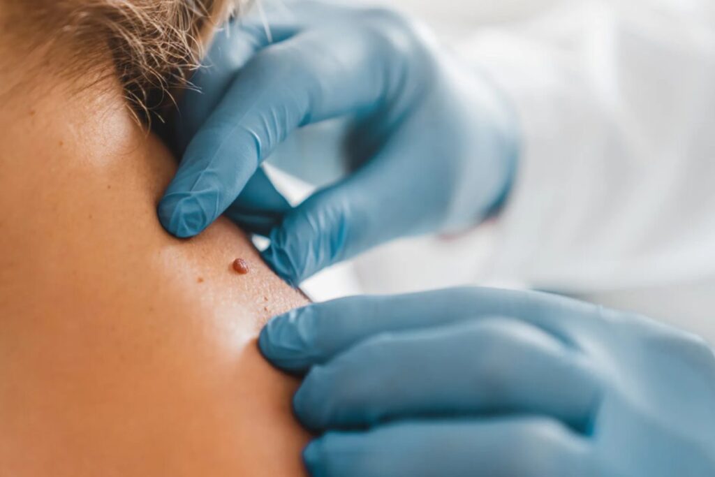 Skin Tags Removal