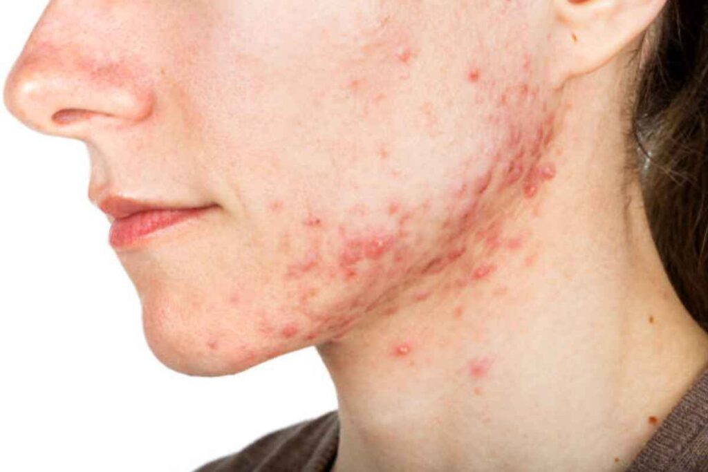Rosacea