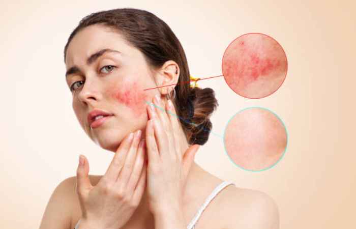 Treatment Options for Rosacea