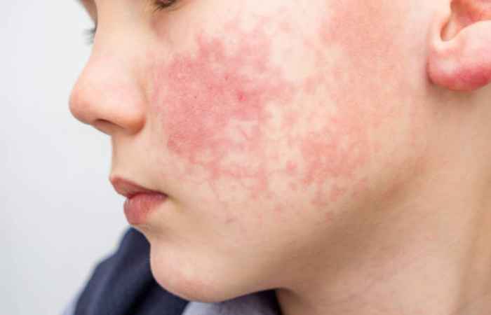 What is Rosacea