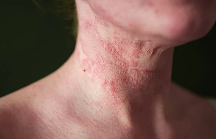 Atopic Dermatitis